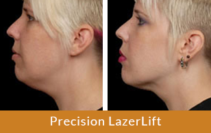 cellulaze
